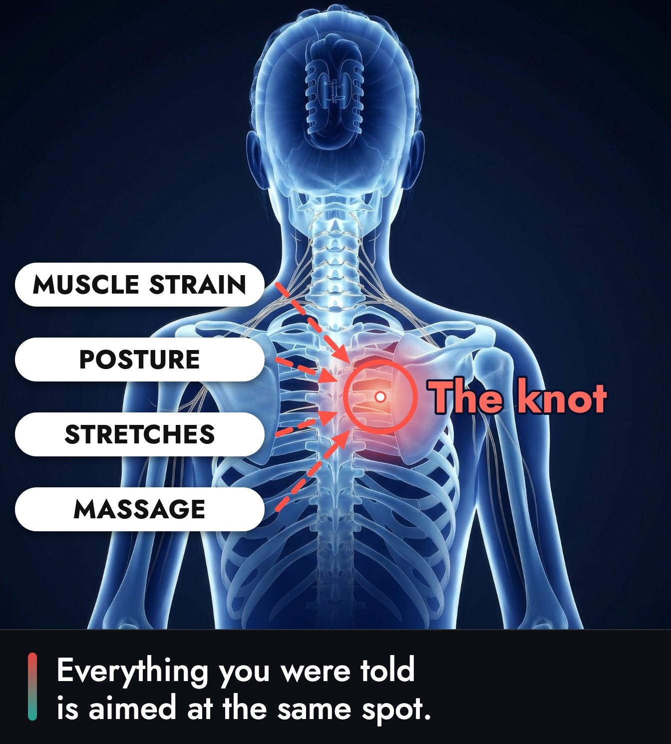 X-ray style illustration of a woman's neck and upper back from behind, with a red ring on the knot beside the inner edge of her right shoulder blade and four arrows pointing at it from the labels Muscle strain, Posture, Stretches and Massage.