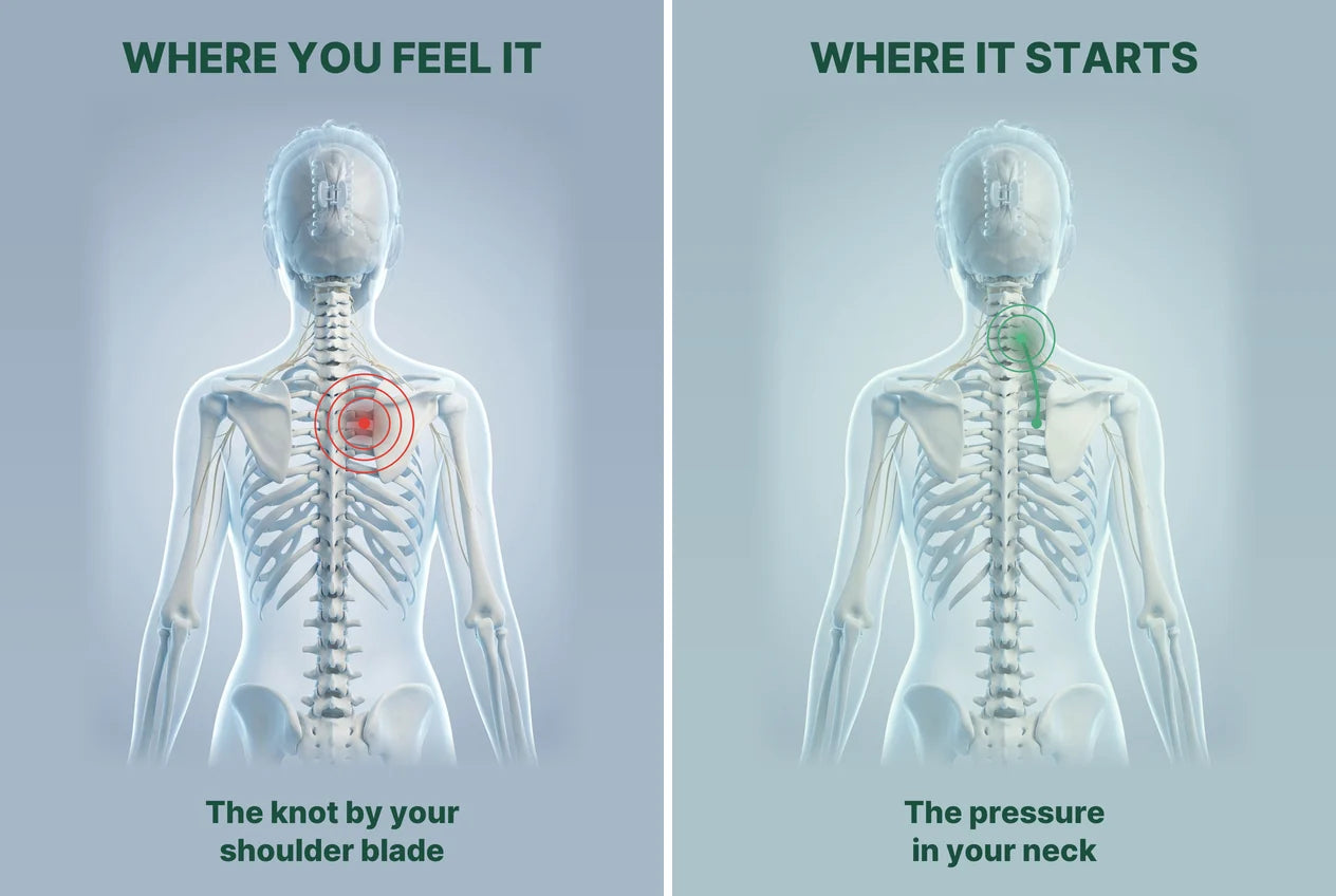 Illustration of her back: where you feel it, the knot by the shoulder blade; where it starts, the pressure in the neck